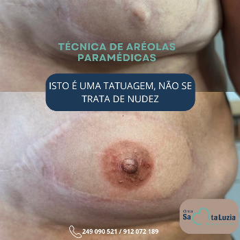 Harmonização Paramédica Aréolar